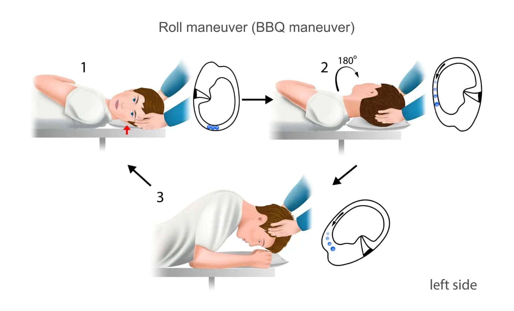 An illustration showing a simple BPPV maneuver called BBQ maneuver to treat lateral canal BPPV. Which is an effective treatment that can fix BPPV in few minutes with proper diagnosis.