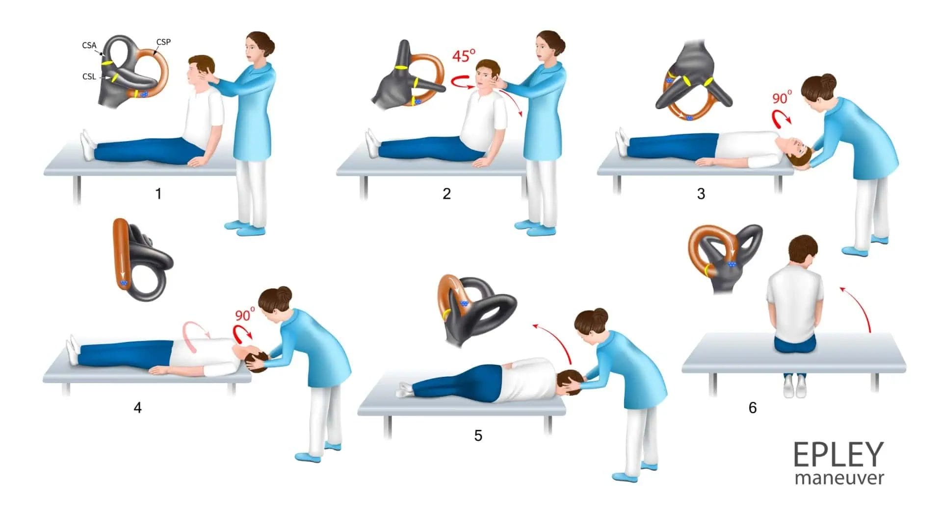 An illustration of Epley maneuver for posterior canal BPPV treatment.