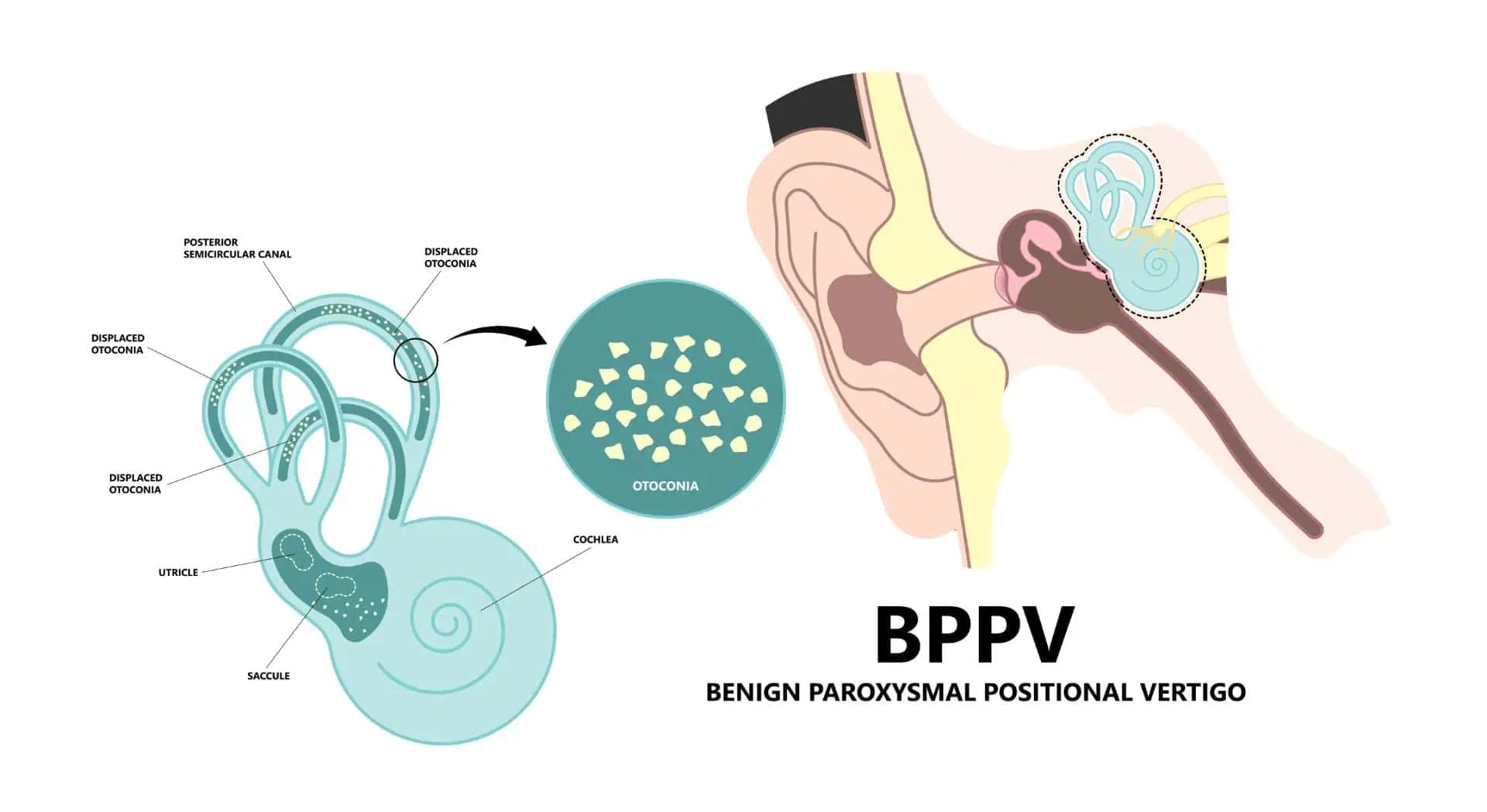 BPPV disorder causing severe vertigo with spinning sensation