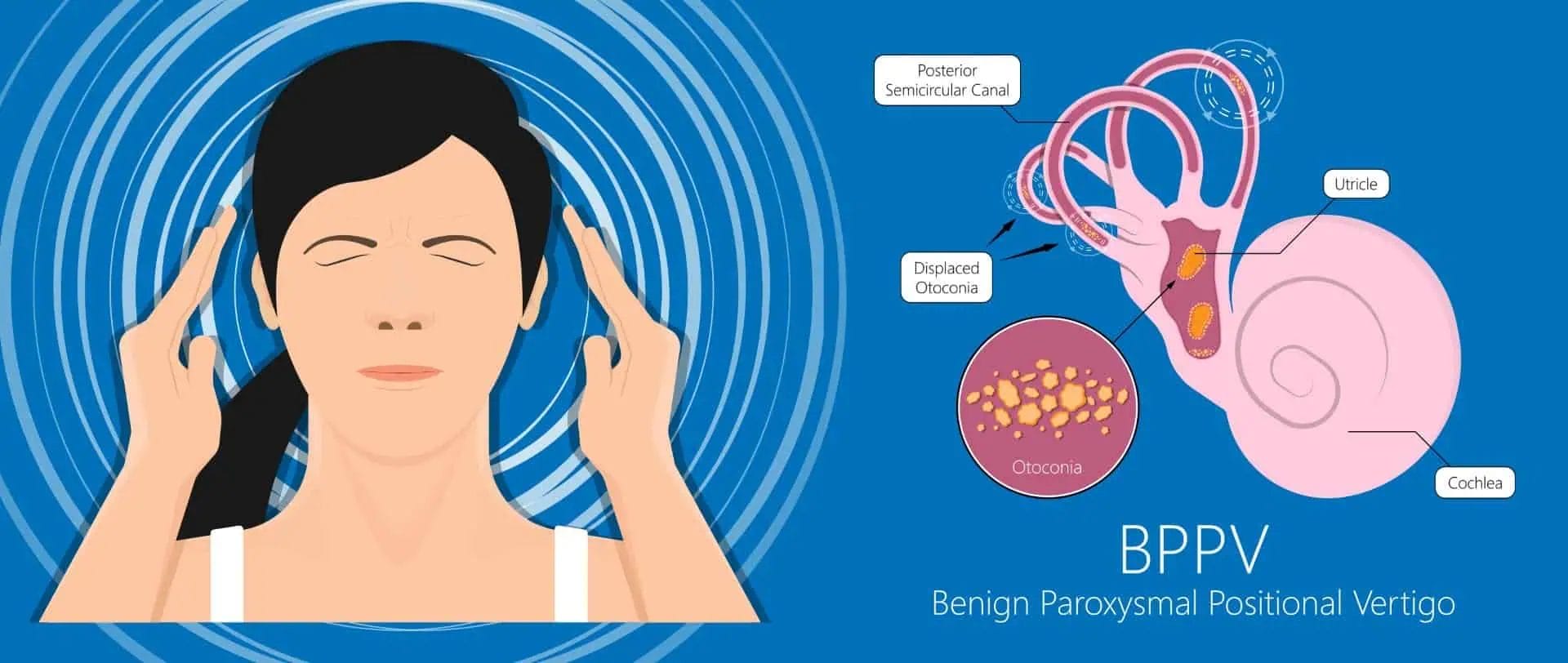 An illustration showing the reason behind the BPPV, where the otoconia, crystals in ear are displaced causing vertigo.