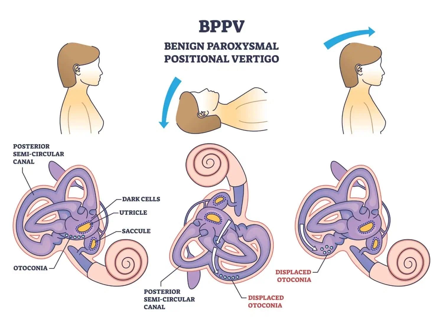 An illustration of showing how BPPV can be trigged, like while a person is trying to lie back as shown in the image