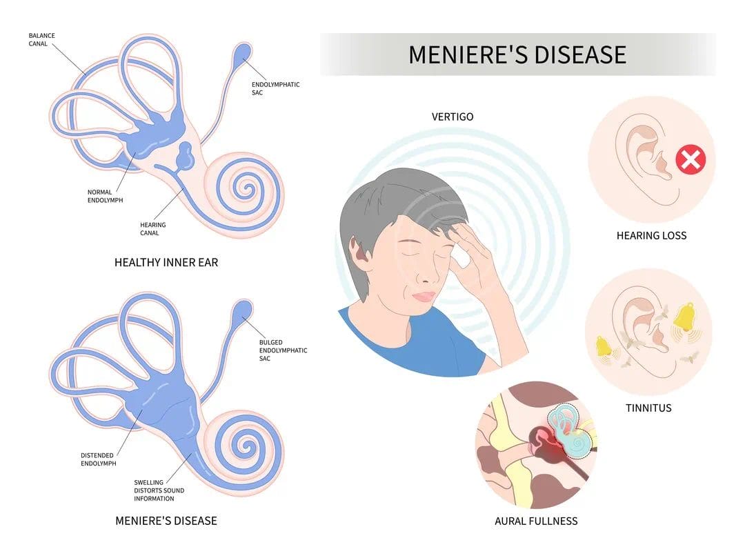 Pathophysiology of Meniere's Disease causing vertigo, hearing loss and tinnitus.