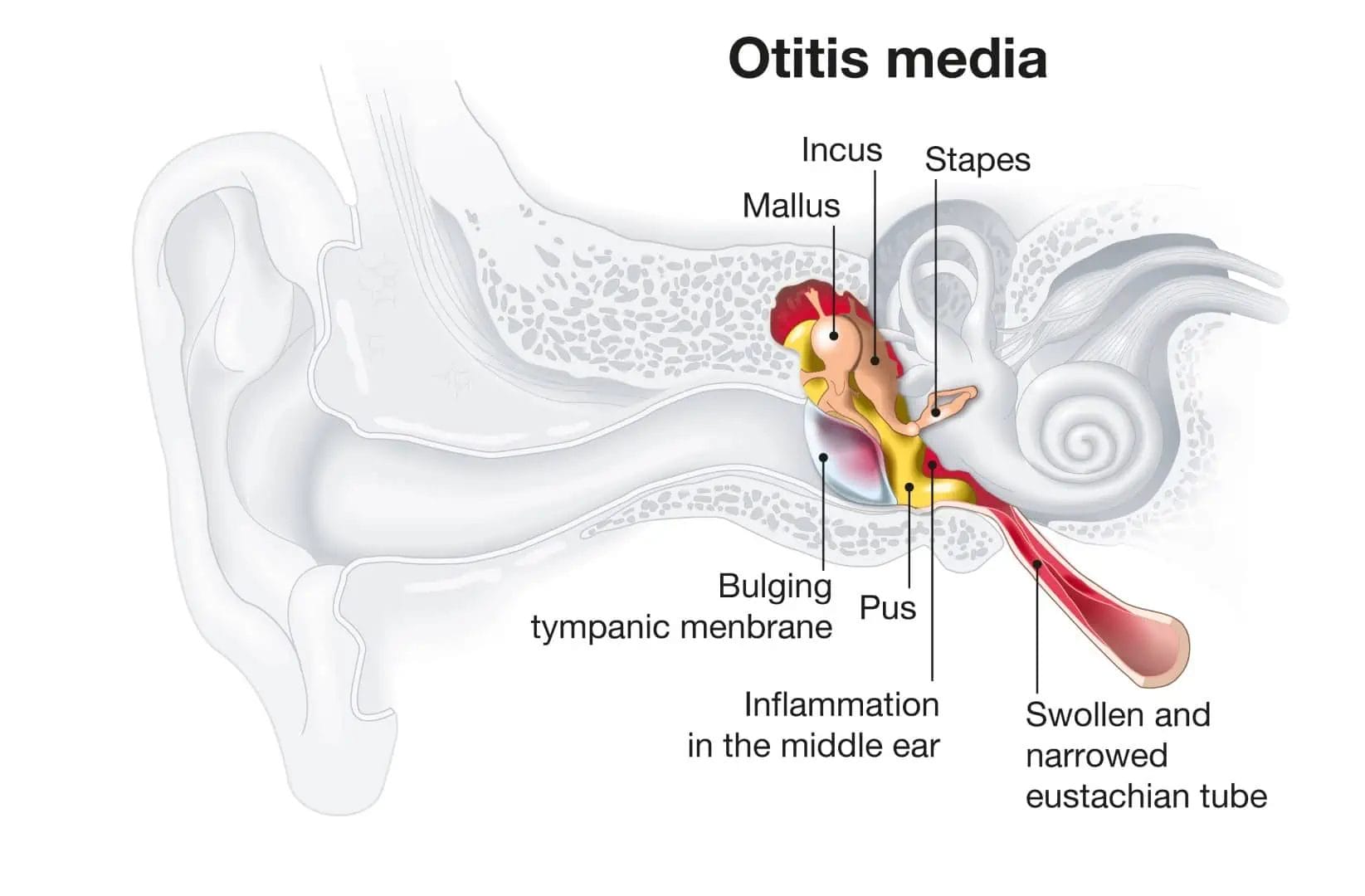 An illustration of ear showing middle ear which prone to middle ear infections leading to conductive hearing loss