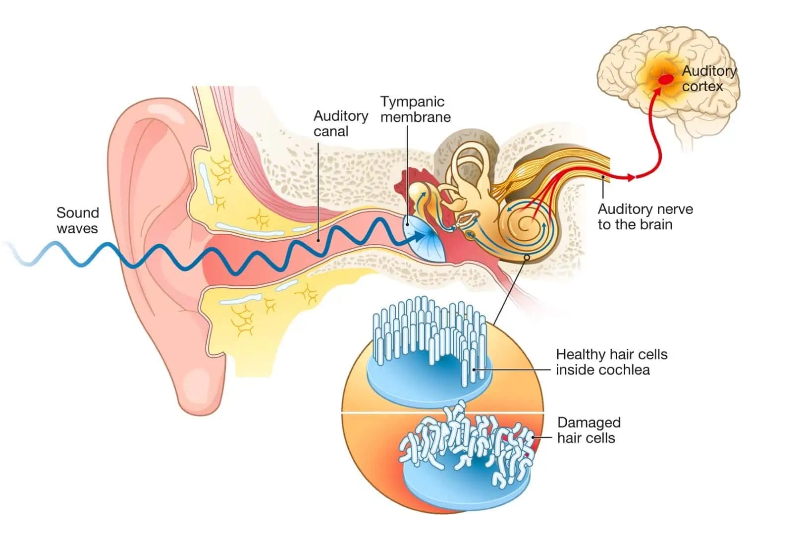An illustration of ear showing damage to inner ear hearing sensors called hair cells causing sensorineural hearing loss