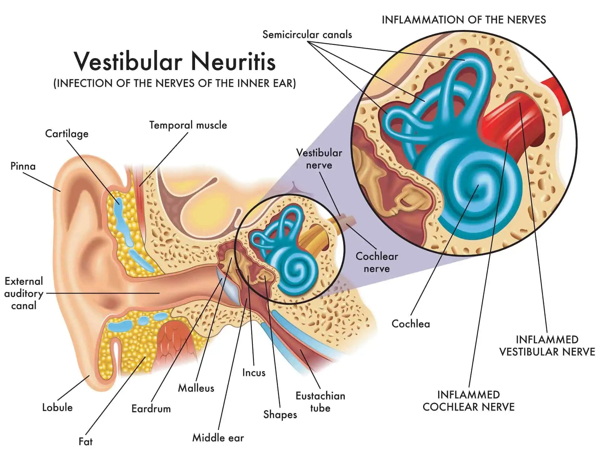 An illustration of ear and its nerve showing inflammation of nerve causing a condition called Vestibular Neuritis